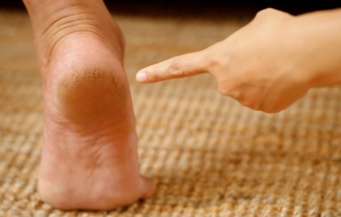 How to fix cracked heels permanently