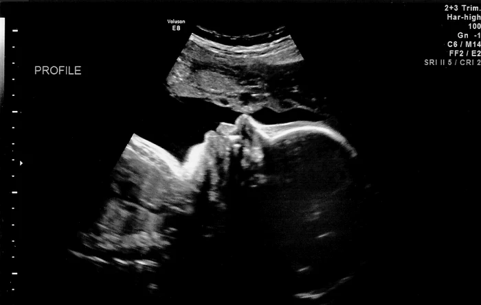 What are the complications of pregnancy